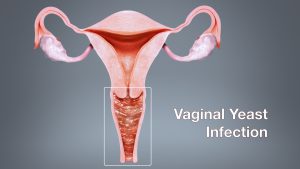 عفونت مخمری واژن