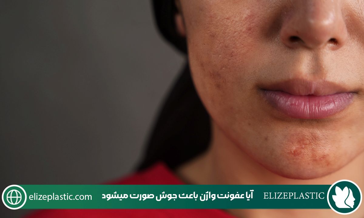 آیا عفونت واژن باعث جوش صورت میشود